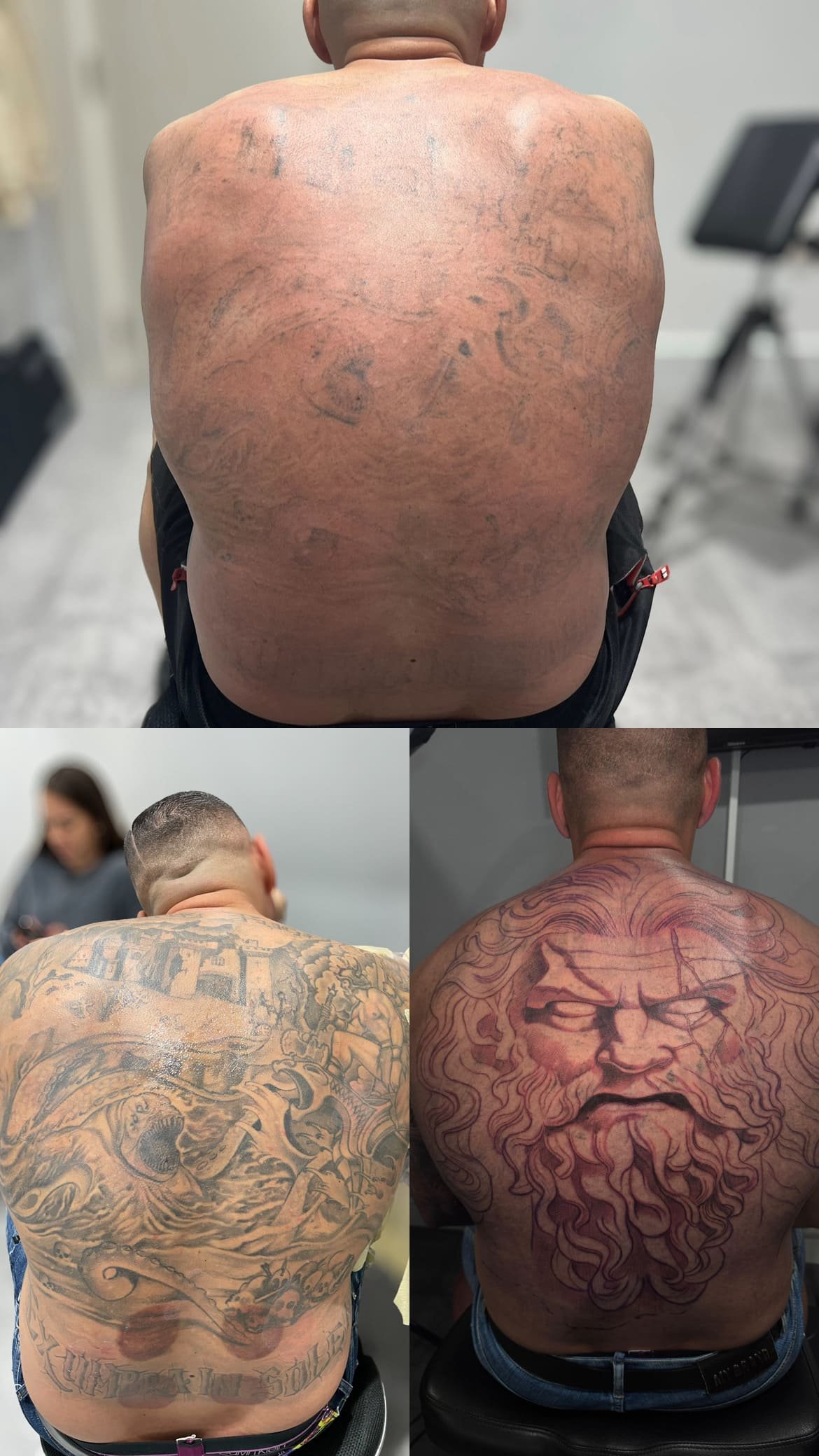 El Proceso de Eliminación de Tatuajes