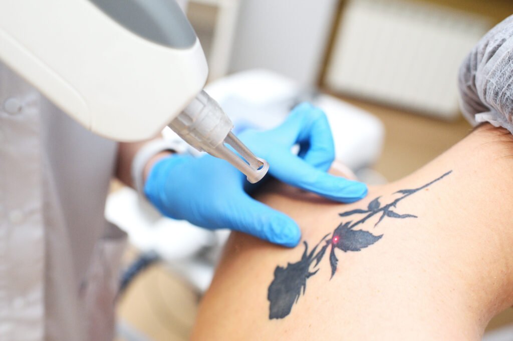 tiempo para quitar tatuaje con láser 