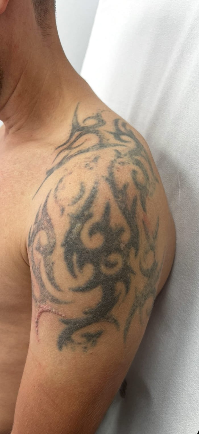 eliminar tatuajes en malaga