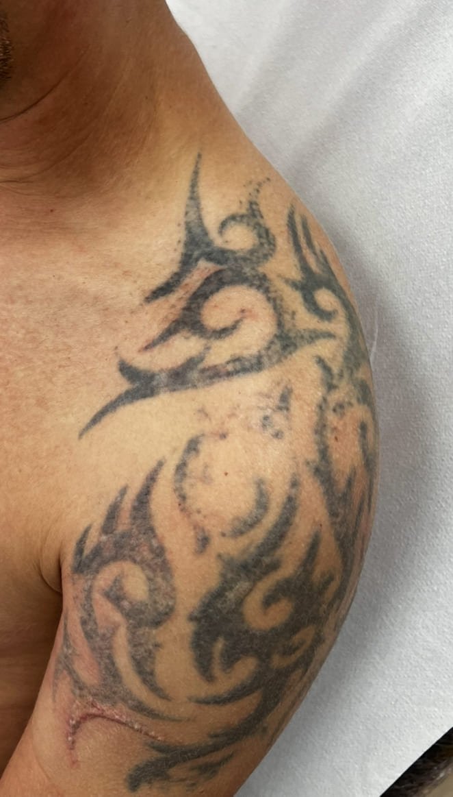 Tatuajes con cicatriz. Qué método usar para eliminar tatuajes en Malaga